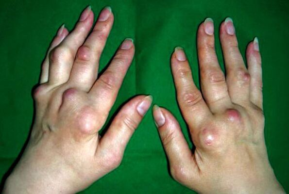 Mâinile afectate de poliosteoartrita deformantă