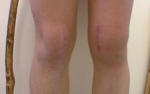 etapele de dezvoltare a artrozei genunchiului