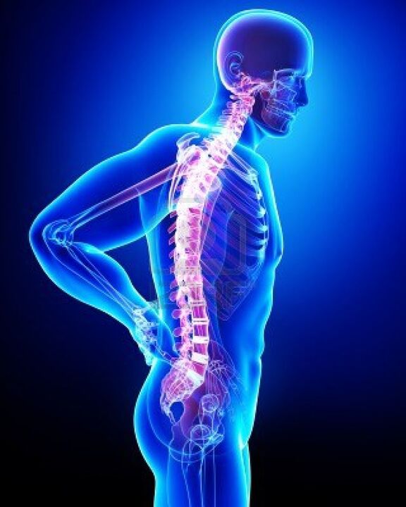 Coloana vertebrală umană afectată de osteocondroză