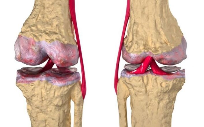 Artroza articulației genunchiului